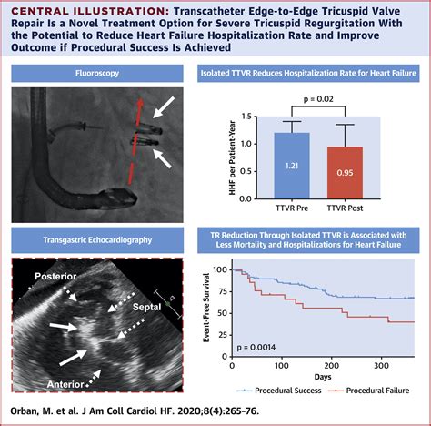 Transcatheter Edge.